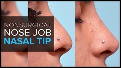 Nonsurgical Nose Job in San Francisco: Fillers for the Nasal Tip