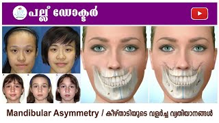 Understanding Mandibular Asymmetry: Causes, Symptoms & Treatment
