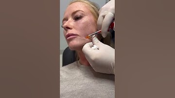Marionette video 1 dermal filler treatment. Performed by cannula by Dr Bart.