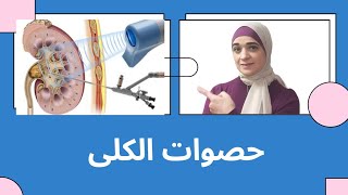 حصوات الكلى