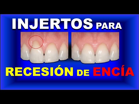 Video: 3 sätt att stoppa tandköttsrecession