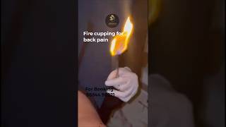Fire cupping  #aeternum