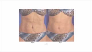 Laser Skin Tightening Frequently Asked Questions - A E Skin - Encino, CA - 818-835-1833