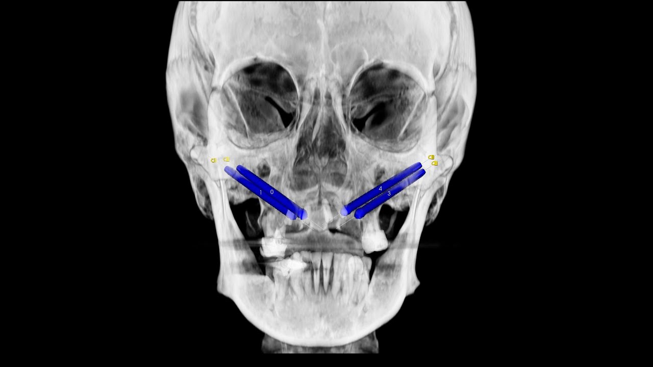 Dr tedesco zygomatic implants piezosurgery implant 3d software youtube