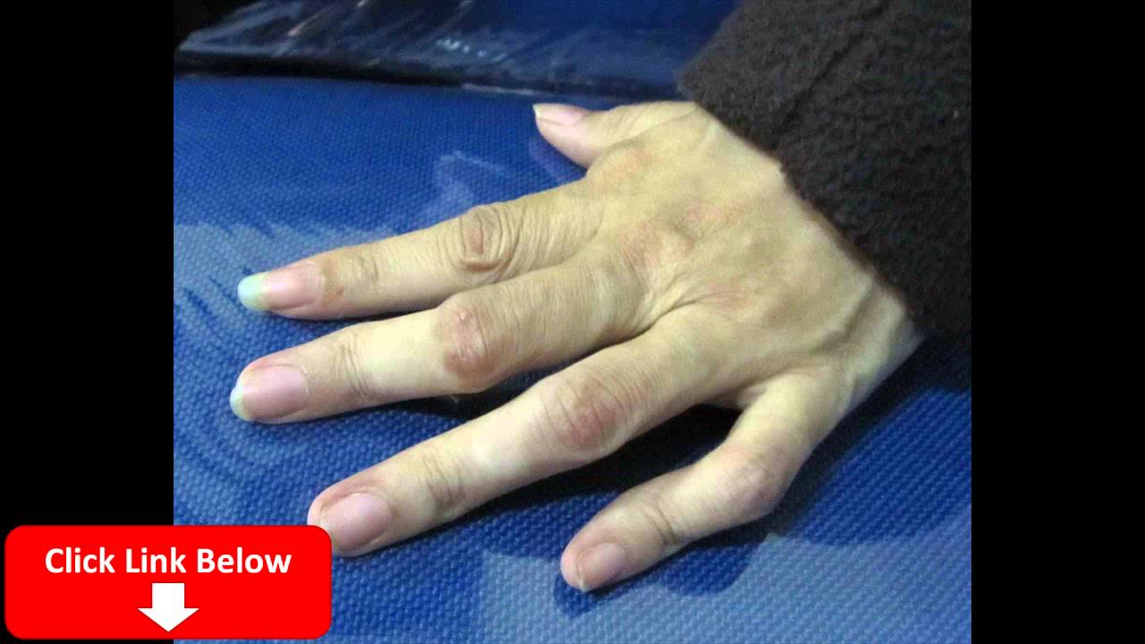 cara mengobati penyakit rematik tulang