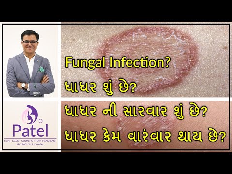 Fungal infection of skin- ધાધર શું છે? Treatment tips In Gujarati by Dr.  Mahesh Patel Dermatologist