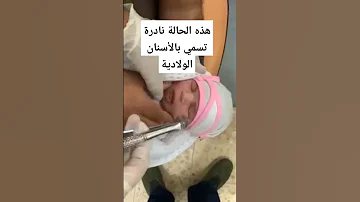 هذه الحالة نادرة تسمى بالأسنان الولادية حيث يظهر سن عند الطفل أثناء الولادة 