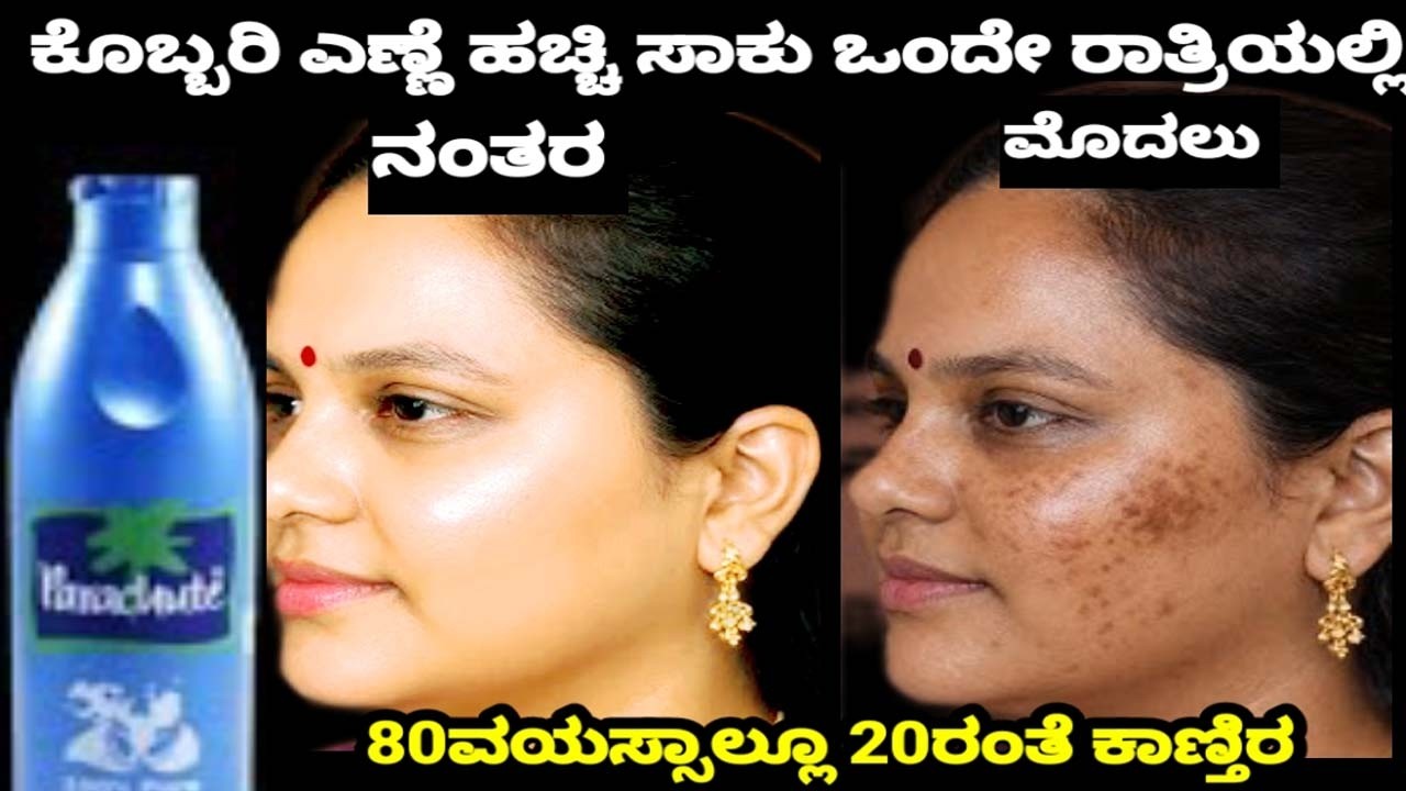 ಒಂದು ಹನಿ ರಾತ್ರಿ ಹಚ್ಚಿ 10 ವರ್ಷಗಳ ಬಂಗು ಮಾಯಾ ಕಪ್ಪು ಚುಕ್ಕಿ ಕಲೆ ಹೋಗುತ್ತೆ ಮುಖ ಕನ್ನಡಿಯಂತೆ ಹೊಳೆಯುತ್ತೆ.
