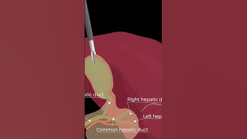 Lap Chole: the first major laparoscopic procedure a resident performs from start to finish
