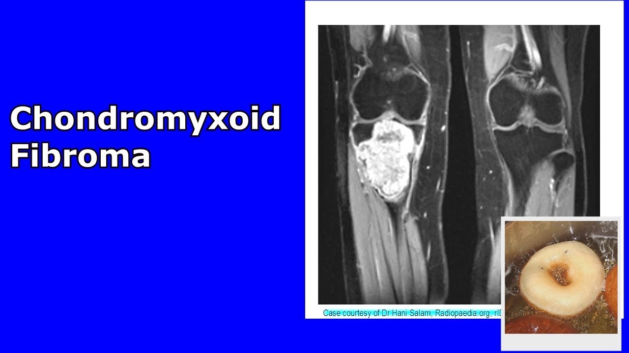 Chondromyxoid Fibroma.