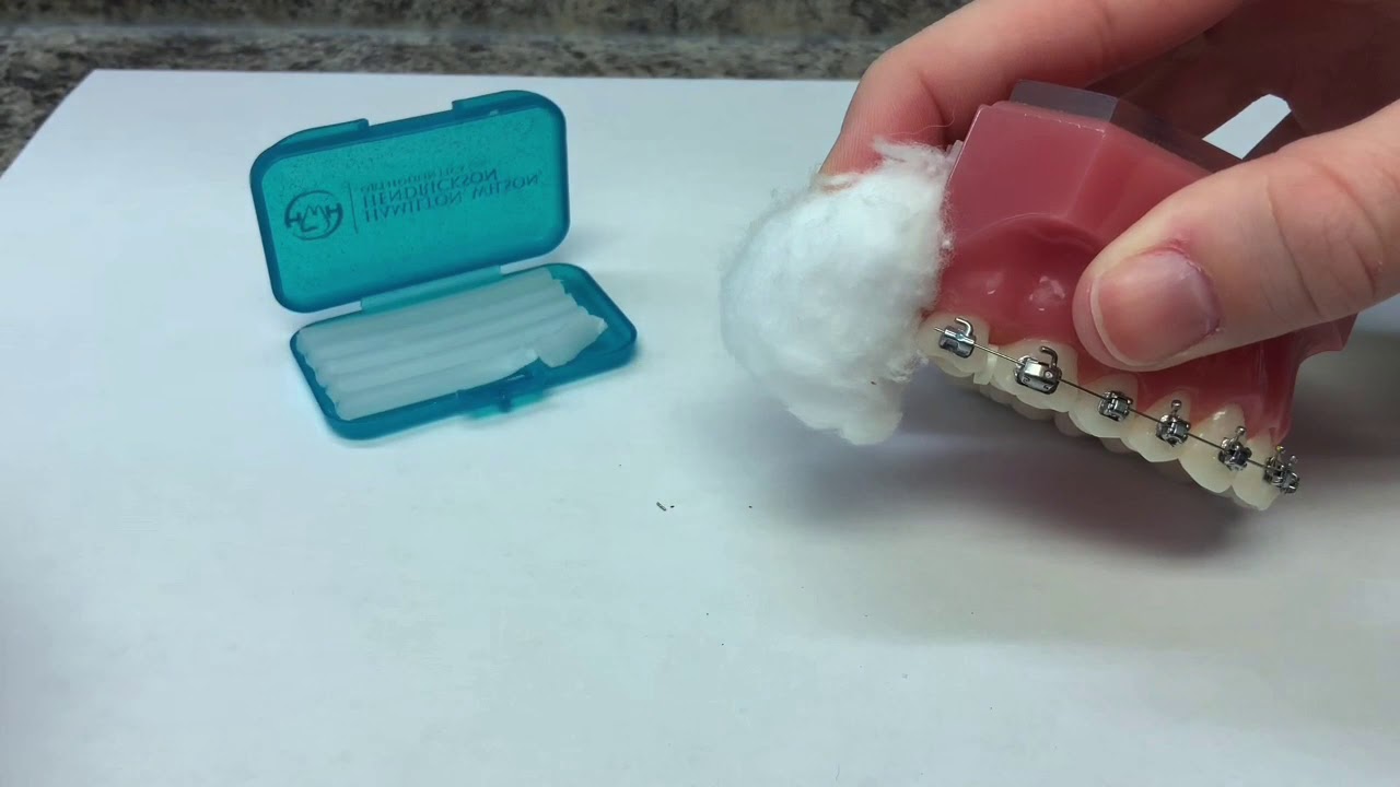 Wilson & Hendrickson Orthodontics How to trim a poking wire YouTube