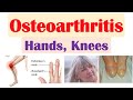 Osteoarthritis (Arthritis of Hands, Knees) | Causes, Risk Factors, Symptoms, Diagnosis, Treatment