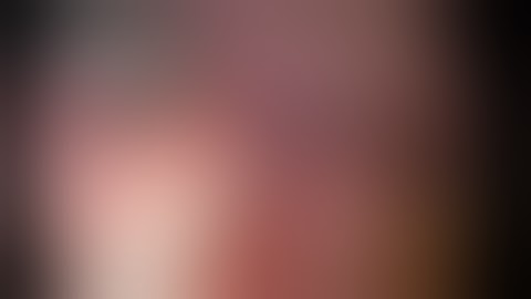 Lap Resection Of A Gastric Gist After Previous Partial Gastrectomy And Billroth II Reconstruction