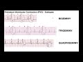 Ekg patterns  premature atrial  ventricular contractions pacs  pvcs