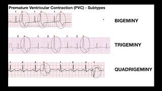 EKG Patterns | Premature Atrial & Ventricular Contractions [PACs & PVCs]