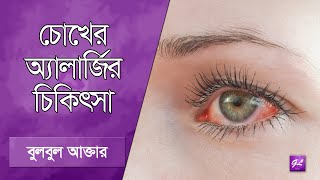 চোখ লাল হওয়া, চুলকানি, পানি পড়া রোগ | Eye allergy treatment | Goodie Life | 2025