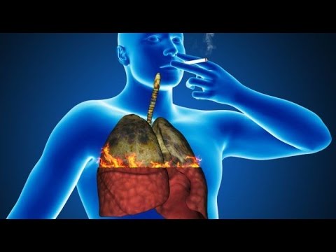 Video: Cigarile Cauzează Cancer? Dovada Este Incontestabilă