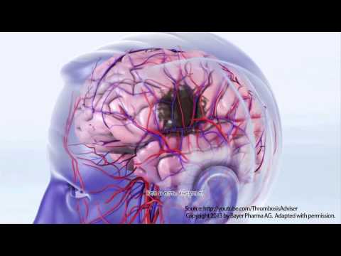 Мерцательная аритмия и