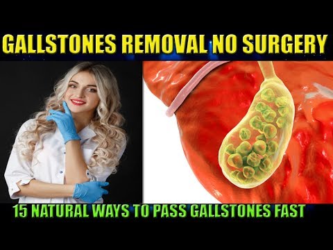 Video: How to get rid of gallstones without surgery