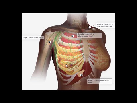سرطان پستان آموزش سه بعدی مراحل ۰ ۴سرطان پستان و متاستاز به سایر ارگان ها