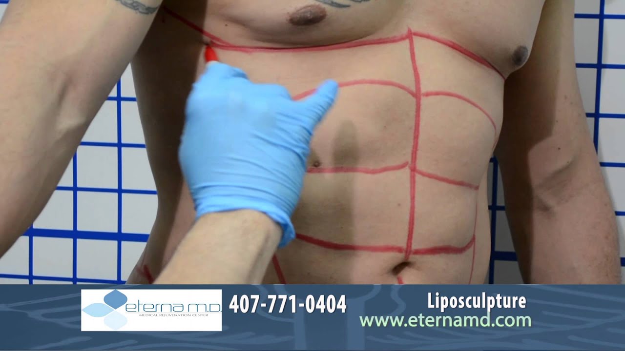 video editing software free Liposculpture