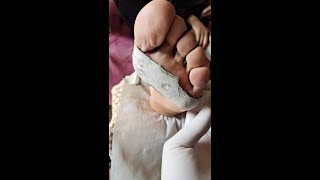 Pedicure Tutorial : Plantar wart removal. The whole process of wart treatment.
