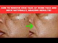 SKIN TAGS, LOOK WHAT I USE TO REMOVE  SKIN TAGS ON MY FACE AND NECK, HOW TO REMOVE SKIN TAGS FAST