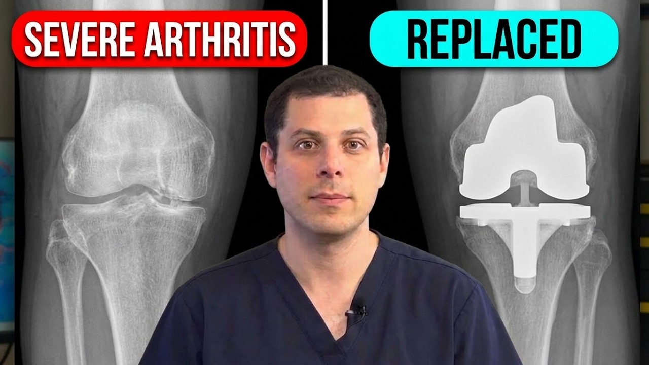 How to tell if you need a knee replacement - YouTube