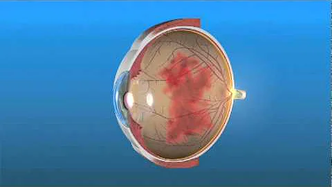 ¿Cómo se limpia el ojo vítreo?