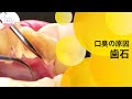 放っておくと口臭の原因に!!歯石除去 It will Cause Bad Breath If You Don't Have Dental Tartar Removal!
