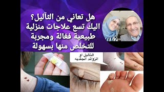 علاج الثآليل.. أسرع وأسهل تسع علاجات طبيعية فعالة ومجربة للتخلص من الثآليل