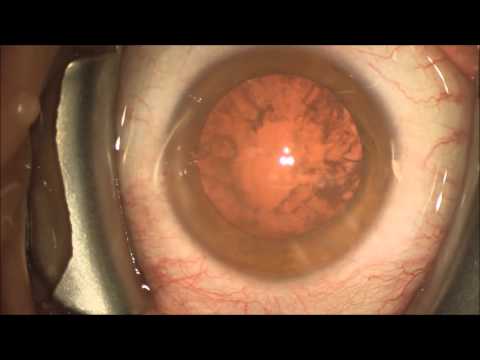 Multi-focal IOL (intraocular lens implant) Technis MF/Restor.5 minutes! Real-time HD 1080