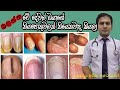 නියපොතු ආසාදන|Nail Infections|Medicine for Life|Dr.Ajitha Iroshan