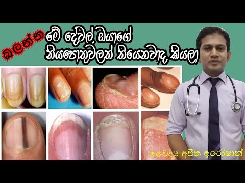 නියපොතු ආසාදන|Nail Infections|Medicine for Life|Dr.Ajitha Iroshan