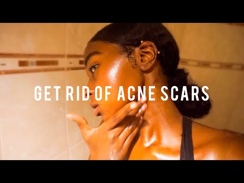 How to Get Rid of Acne Scars in a Week !!!