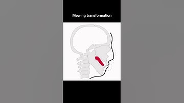Insane MEWING transformation #shorts #mewing