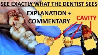 Upper and Lower Right Wisdom Tooth Removal (Extraction) - Full Surgery Walkthrough Sydney Australia by Dr Paul's Dental World 12,462 views 1 year ago 5 minutes, 36 seconds