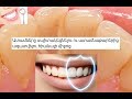 Ատամները սպիտակեցնելու ու ատամնաքարերից ազատվելու հիանալի միջոց