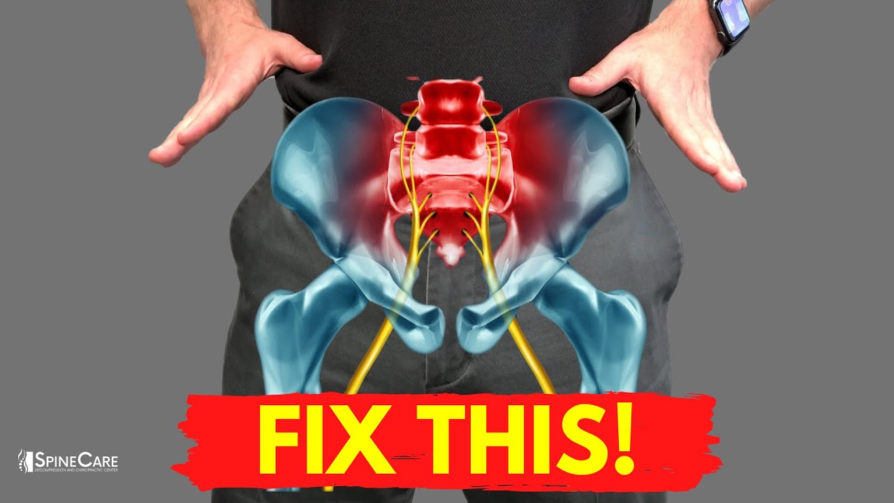 Sciatica Pain Relief - Anatomy & Definition — Revive Sport & Spine