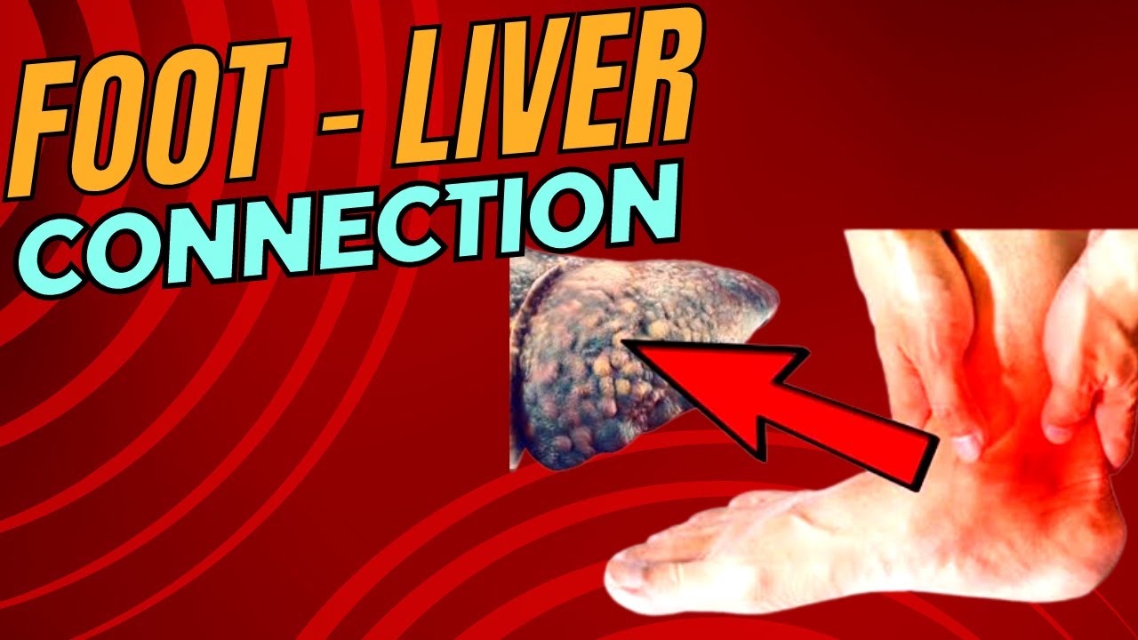 5 Signs of Liver Problems From Your Feet Liver Disease Symptoms YouTube