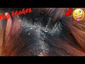 Dandruff Removal Satisfying!! Itchy Psoriasis Scalp Scratching #740