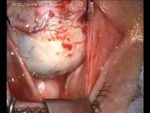 Video: Scleral Buckling: Chirurgie, Podrobnosti Procedury A Doba Zotavení