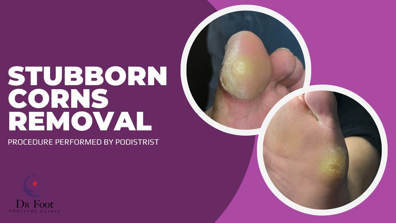 Managing Stubborn Corns by a Podiatrist YouTube