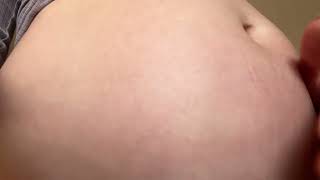 Bloated belly - Annabelle S.