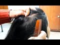 😊🌜 #haircombing #dandruffscratching #scalpcheckasmr #carikutu #licepicking #tickremoval #grooming