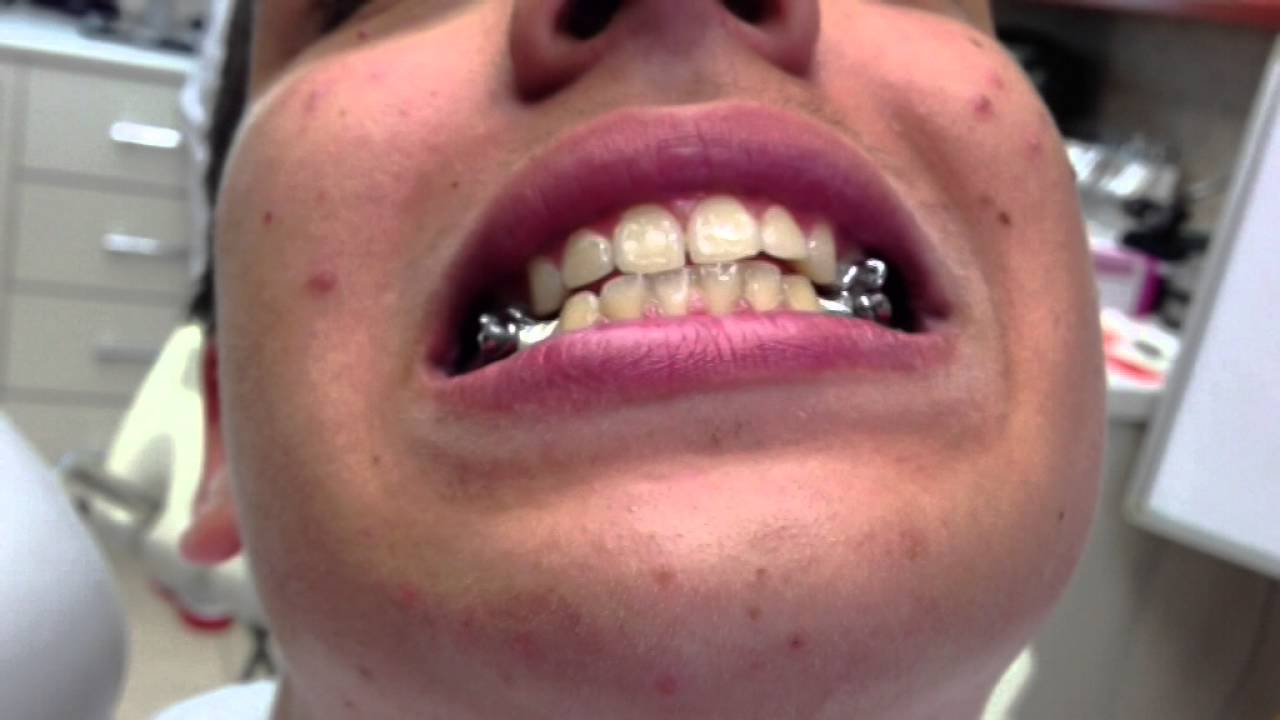 Hebst appliance | Athanasios Nasiopoulos Orthodontist Thessaloniki - Edinburgh