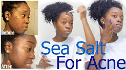 Clear Acne & Dark Spots FAST w/Sea Salt !!!