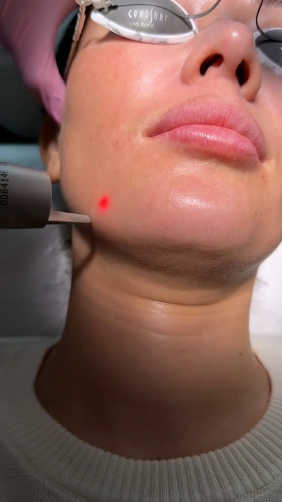 Got Picosure Laser to treat my melasma and as you can see there’s very minimal downtime. #skincare