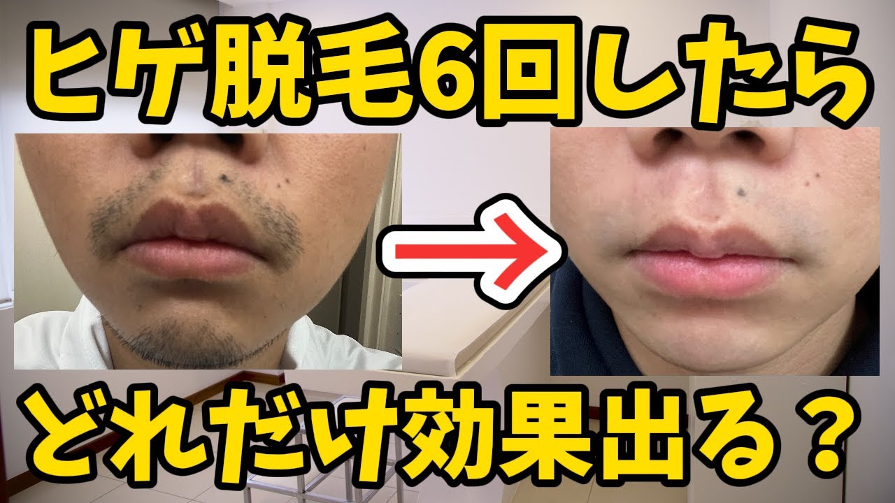 【ヒゲ医療脱毛】6回したらどれだけ効果出る？？【1週間写真撮って比較してみた】