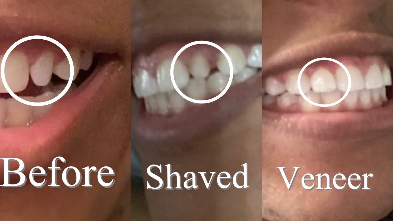 Veneers What Happens When Not Wearing Retainer 😳before And After Braces Youtube